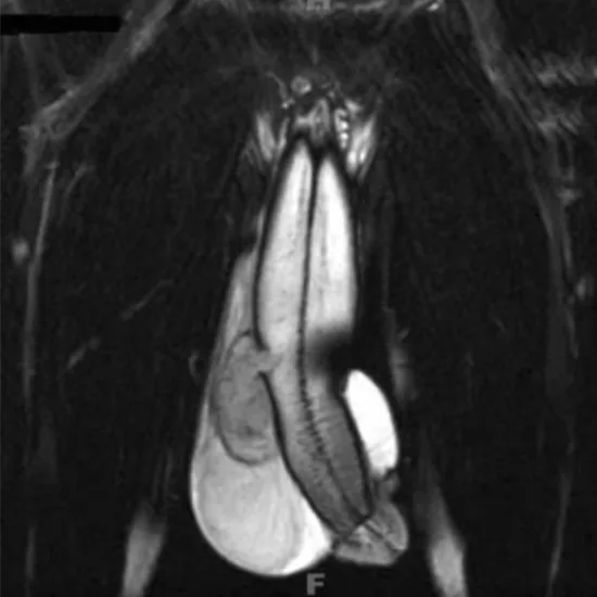 MRI Penis